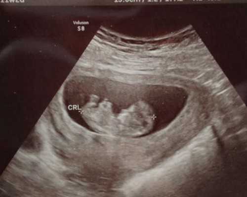 昆明供卵代孕包成功,试管婴儿有什么坏处？这几点也许很多人都想到了-孕妇梦